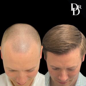 Hair Transplant Before and After Photo by Dr. Demetri in Beverly Hills California