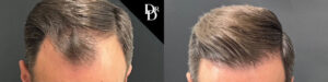 Hair Transplant Before and After Photo by Dr. Demetri in Beverly Hills California